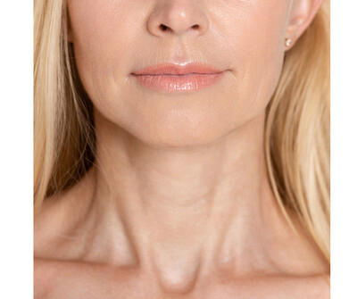 Advance Neck Lift Treatment